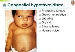 Mẹ bị bệnh tuyến giáp trong thai kỳ, con có cần sàng lọc?