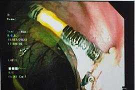 Vòng tránh thai đâm xuyên tử cung làm thủng đại tràng