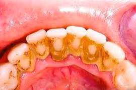 Chuyên gia chỉ rõ lý do viêm lợi và cách chữa