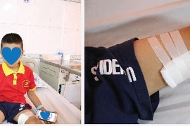 2 trẻ bị nhiễm tụ cầu vàng do chó cắn