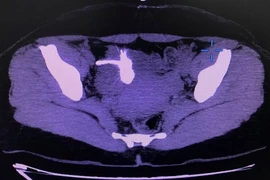 Sỏi bám kín vòng tránh thai đi lạc vào trong bàng quang