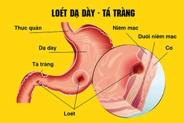 Bị viêm loét dạ dày: Nên ăn gì vào buổi sáng?