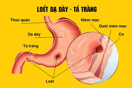 Bác sĩ chỉ rõ tác nhân gây viêm loét dạ dày, hành tá tràng