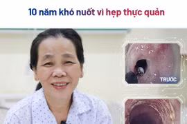 Cắt màng ngăn thực quản giúp người bệnh 56 tuổi thoát khỏi nuốt nghẹn 10 năm