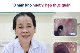 Cắt màng ngăn thực quản giúp người bệnh 56 tuổi thoát khỏi nuốt nghẹn 10 năm