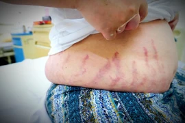 Lạm dụng thuốc xịt mũi, hai anh em ruột bị suy tuyến thượng thận