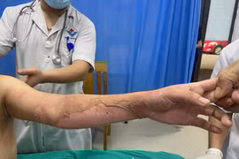 Dùng cồn nướng thức ăn nữ bệnh nhân 26 tuổi bỏng nặng