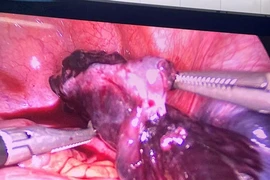 Bảo tồn thành công buồng trứng xoắn cho trẻ 5 tuổi