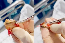 Bất ngờ vòng tránh thai bọc trong khối u xơ tử cung