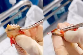 Bất ngờ vòng tránh thai bọc trong khối u xơ tử cung