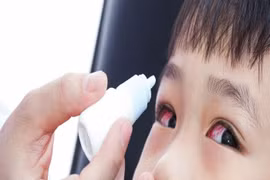 Liệu pháp 6 “KHÔNG” bảo vệ bản thân và gia đình không bị đau mắt đỏ