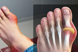 Chữa gút đơn giản với thực phẩm và thuốc nam quanh nhà