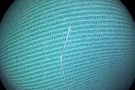 Gây mê lấy xương cá hóc vùng hạ họng