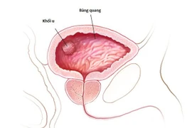 Bác sĩ chỉ rõ dấu hiệu và cách điều trị ung thư bàng quang