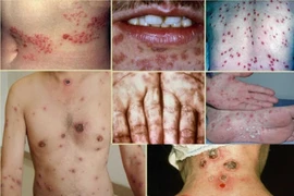 Bệnh giang mai – “kẻ trá hình hoàn hảo” đang gia tăng ở giới trẻ