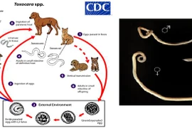 Đau bụng, sút cân đi khám bất ngờ phát hiện Abcess gan do giun đũa chó