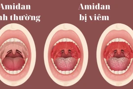 Bác sĩ chỉ rõ biến chứng và đối tượng cần cắt viêm amidan