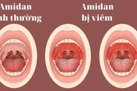 Bác sĩ chỉ rõ biến chứng và đối tượng cần cắt viêm amidan