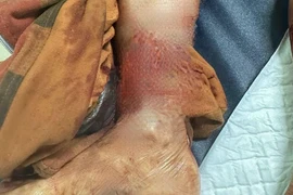 Chó nhà cắn đứt rời chân chủ nguy kịch