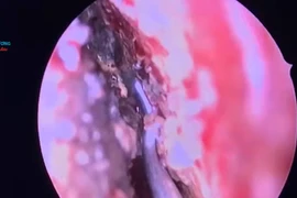 Bé trai 4 tuổi hoại tử mũi vì pin cúc áo