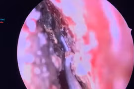 Bé trai 4 tuổi hoại tử mũi vì pin cúc áo