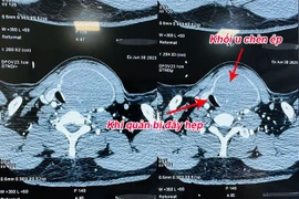Khối u vỡ chèn ép khí quản bệnh nhân