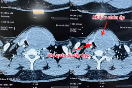 Khối u vỡ chèn ép khí quản bệnh nhân