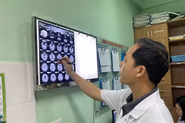 Đặt điện cực kích thích não sâu điều trị Parkinson