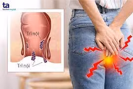 Chuyên gia mách cách ăn, uống để phòng và chữa trĩ