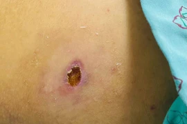 Viêm cơ tim, suy đa tạng vì sốt mò: Bác sĩ chỉ cách phòng tránh