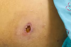 Viêm cơ tim, suy đa tạng vì sốt mò: Bác sĩ chỉ cách phòng tránh