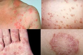 Bệnh lậu ảnh hưởng đến thai nhi như thế nào?