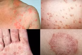 Bệnh lậu ảnh hưởng đến thai nhi như thế nào?