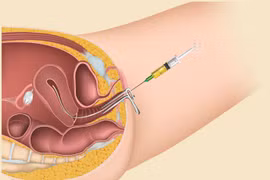 Điều kiện để tiến hành thụ tinh nhân tạo