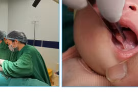 Khi nào cắt dính thắng lưỡi cho trẻ?