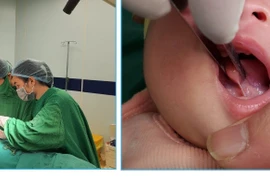 Khi nào cắt dính thắng lưỡi cho trẻ?