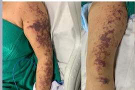 Ăn lòng lợn, người phụ nữ 59 tuổi sốc nhiễm khuẩn do mắc liên cầu lợn