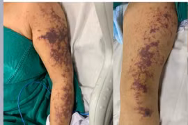 Ăn lòng lợn, người phụ nữ 59 tuổi sốc nhiễm khuẩn do mắc liên cầu lợn