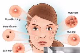 7 nguyên tắc giúp trị mụn trứng cá hiệu quả