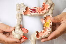 Sự nguy hiểm của viêm đại tràng nhiều người không biết