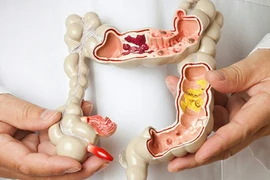 Sự nguy hiểm của viêm đại tràng nhiều người không biết