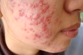Điều trị mụn trứng cá sớm tránh sẹo rỗ