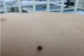 Lần đầu tiên tại miền Nam: Cứu sống bé gái nguy kịch vì bệnh sốt mò 