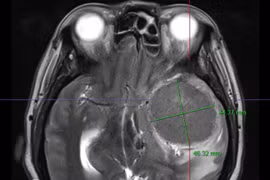 Đau đầu bất ngờ phát hiện u màng não khổng lồ ăn sâu vào não