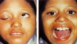 Mắt bị kéo ngược khi nhai hoặc nói, bệnh gì?