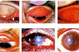 Điều bắt buộc phải chú ý để tránh biến chứng khi đau mắt sau mưa lũ