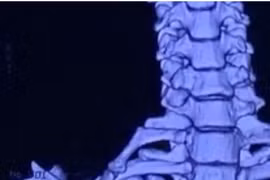 Hy hữu: Cô gái 22 tuổi có xương sườn mọc ở cổ