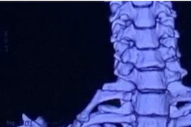 Hy hữu: Cô gái 22 tuổi có xương sườn mọc ở cổ