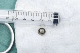 Viên pin tròn rơi vào phổi, trẻ 8 tháng đe dọa ngạt thở