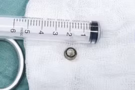 Viên pin tròn rơi vào phổi, trẻ 8 tháng đe dọa ngạt thở